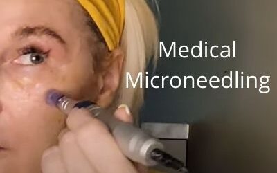 Medical Microneedling