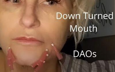 Down Turned Mouth |  DAOs | Ear Lobes |  Aquashine | G-Line Gold Threads 99.99%  | Acecosm.com