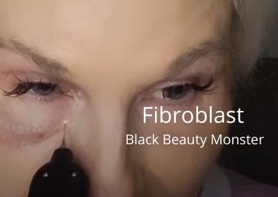 Fibroblast | Black Beauty Monster |  Getglowingnowskincare.com