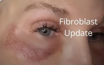 Fibroblast Update and DIY55.com Update