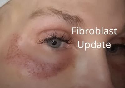 Fibroblast Update and DIY55.com Update