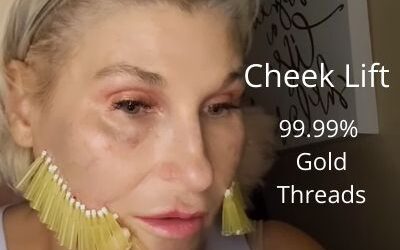 Cheek Lift with G line PDO Threads –  99.99% gold