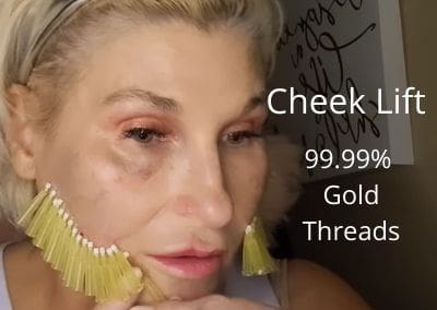 Cheek Lift with G line PDO Threads –  99.99% gold