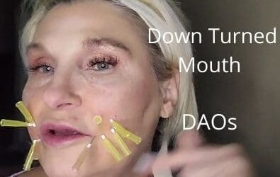 Down Turned Mouth | DAOs | Quick Thread Lift