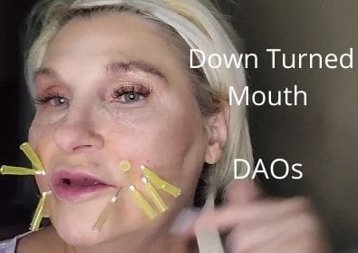 Down Turned Mouth | DAOs | Quick Thread Lift
