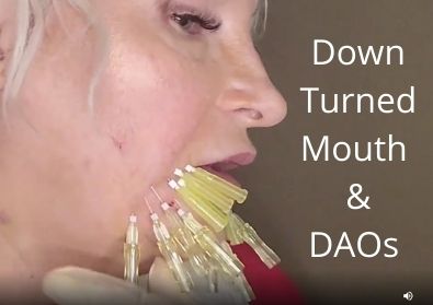 Down Turned Mouth | DAOs | Very Quick Thread Pattern