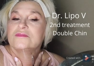 Dr. Lipo V | 2nd treatment | Double Chin