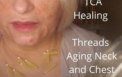 Empowered TCA Healing | Threads 30g 38mm | Aging Neck and Chest