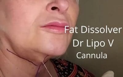 Fat Dissolver – Dr Lipo V | Cannula|  Double Chin