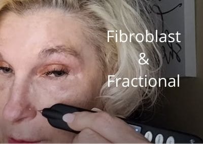 Fibroblast Nasal Area – Nose | Fractional Entire Face | Get Glowing Now Skin Care