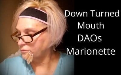 Fix Down Turned Mouth | DAOs | Marionette Lines (this video is 6 months old)