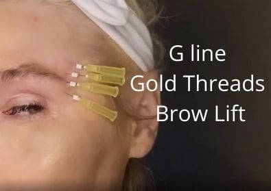 G line gold threads |99.99% longevity |  Brow Lift Aging Eye | Acecosm.com