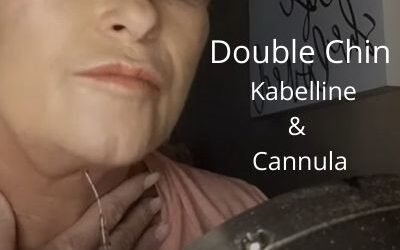 Get rid of Double Chin | Kabelline – Fat Dissolver