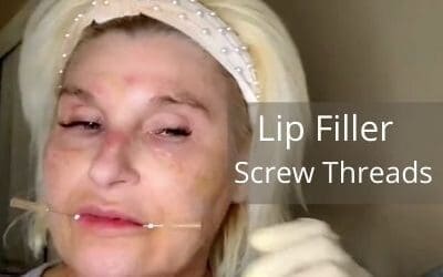 Lip Filler – Screw Threads