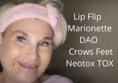 Lip Flip | Marionette | DAO | Crows Feet | Neotox TOX