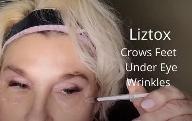 Liztox | Crows Feet | Under Eye Wrinkles | Frozen in time