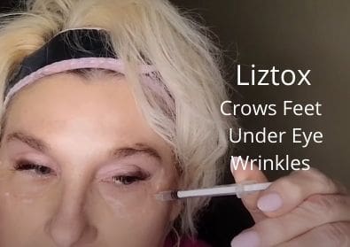 Liztox | Crows Feet | Under Eye Wrinkles | Frozen in time