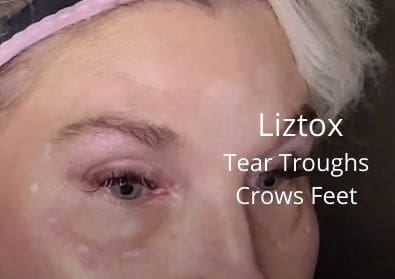 Liztox | Tear Troughs | Crows Feet