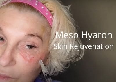 Meso Hyaron | Skin Rejuvenation