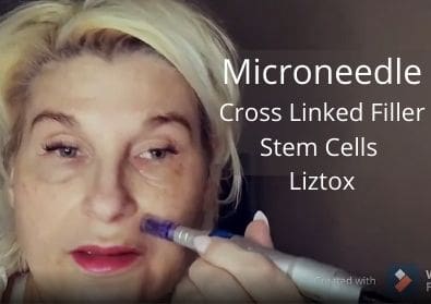 Microneedle Cross Linked Filler, Stem Cells Liztox