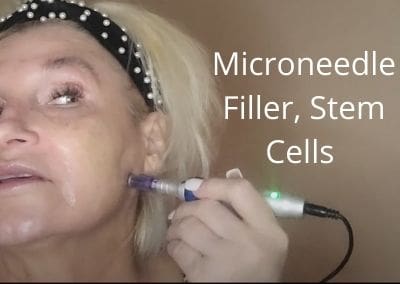 Microneedle | Filler, Stem Cells | Martini for the Face