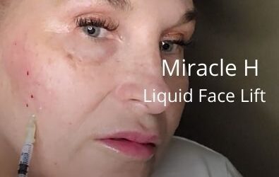Miracle H – Liquid Face Lift