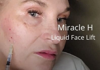Miracle H – Liquid Face Lift