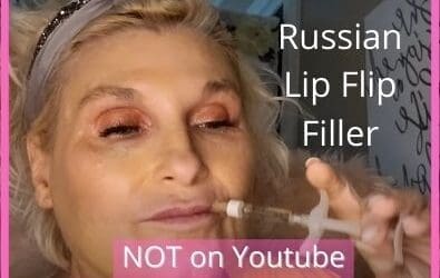 Russian Lip Flip using Filler | Video Not on Youtube