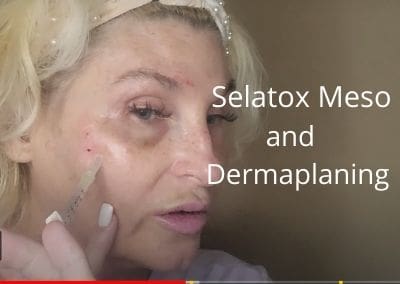 Selatox Meso | Mesotherapy | Dermaplaning