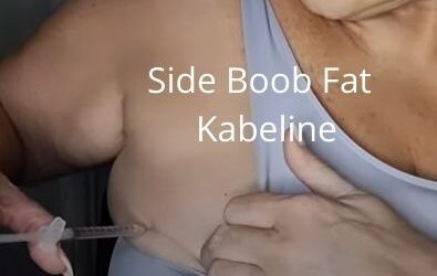 Side Boob Fat | Kabeline | Getglowingnowskincare.com