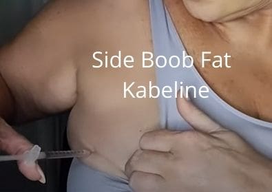 Side Boob Fat | Kabeline | Getglowingnowskincare.com