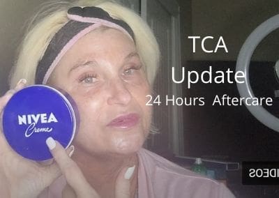 TCA Update – 24 Hours | Aftercare | Beginner Peel |