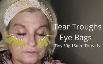 Tear Troughs | Eye Bags | Tiny 30g 13mm Threads