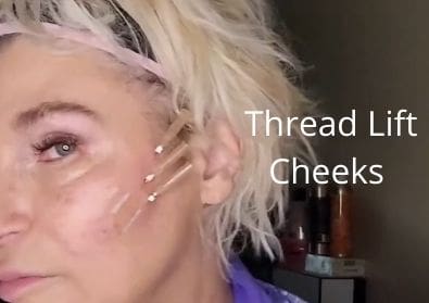 Thread Lift | Cheeks |For Aging Face