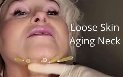 Threads | Loose Skin Aging Neck | #neck Lift