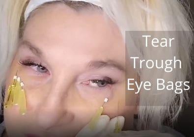 Threads Tear Trough | Eye Bags | How I save Threads