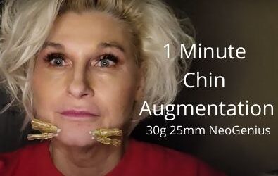 1 minute Chin Augmentation | 30g 25mm NeoGenius