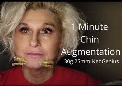 1 minute Chin Augmentation | 30g 25mm NeoGenius