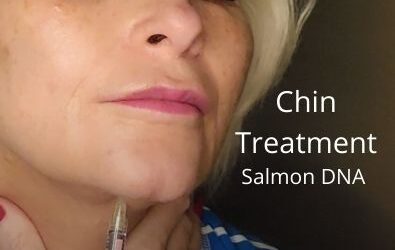 Chin Treatment | Salmon DNA | Huge giveaway