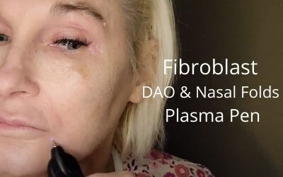 Fibroblast DAO and Nasal folds | Plasma Pen