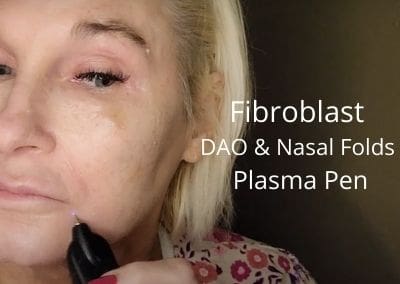 Fibroblast DAO and Nasal folds | Plasma Pen