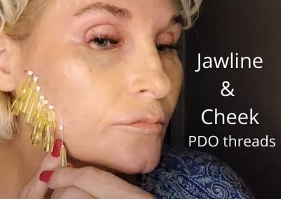 Jawline and Cheek Definition |  PDO threads