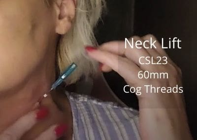 Neck Lift | CSL23 60mm Cog Threads | Acecosm