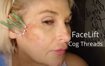 FaceLift with Cog Threads | Nonsurgical FaceLift