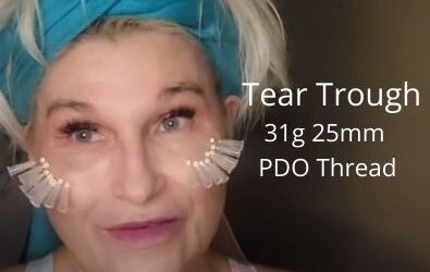 Tear Trough | 31g 25mm PDO Thread