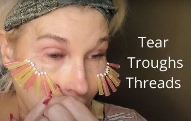 Tear Troughs – PDO Threads | Acecosm.com