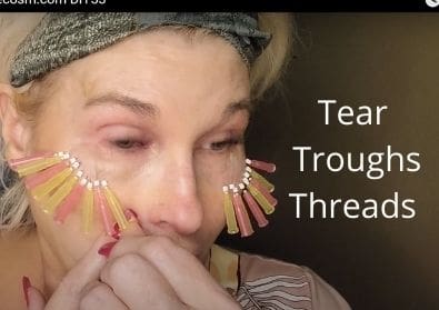 Tear Troughs – PDO Threads | Acecosm.com
