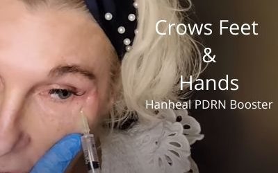 Crows Feet and Hands – Hanheal PDRN Booster
