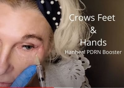 Crows Feet and Hands – Hanheal PDRN Booster
