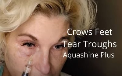 Crows Feet and Tear Troughs – Aquashine Plus Meso